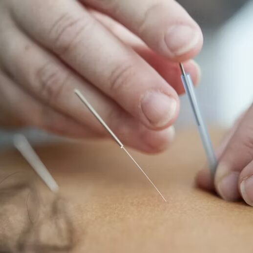 Acupuncture Dry Needling